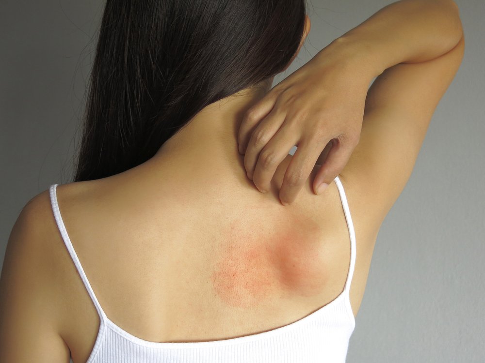 Аллергия кожная ткань